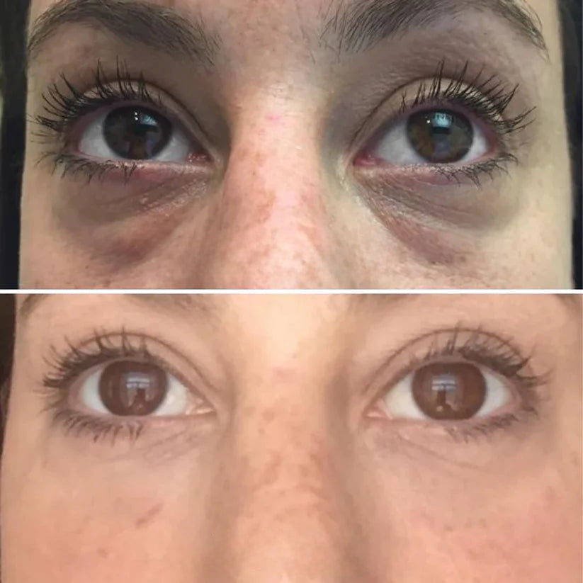 Korean Micro-needling Eye Patches