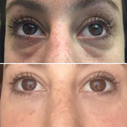 Korean Micro-needling Eye Patches