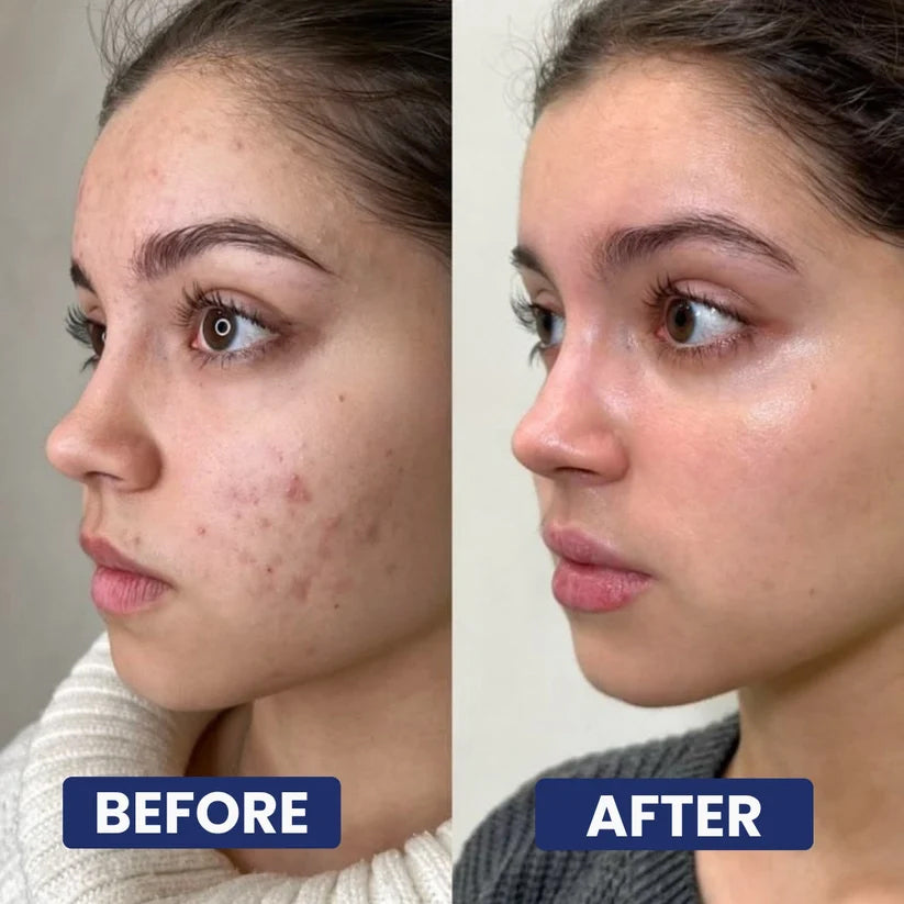 DIYSTAR Acne Drying Lotion Plus Acne Spot Treatment 20 mL