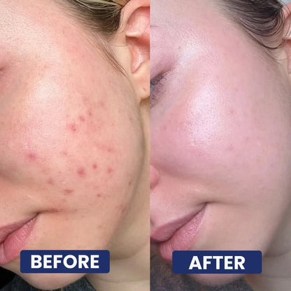 DIYSTAR Acne Drying Lotion Plus Acne Spot Treatment 20 mL