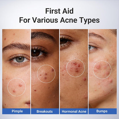 DIYSTAR Acne Drying Lotion Plus Acne Spot Treatment 20 mL